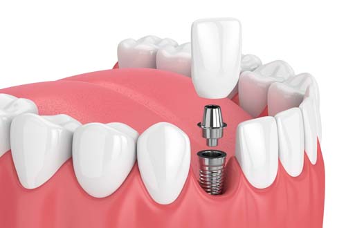 Имплантация зубов: этапы установки и сроки