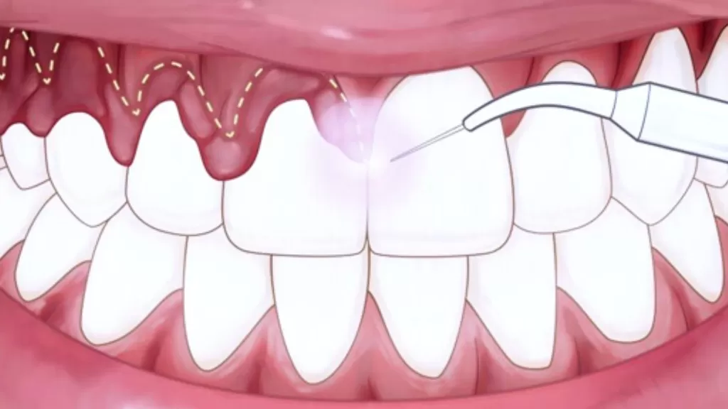 этапы гингивэктомии десен