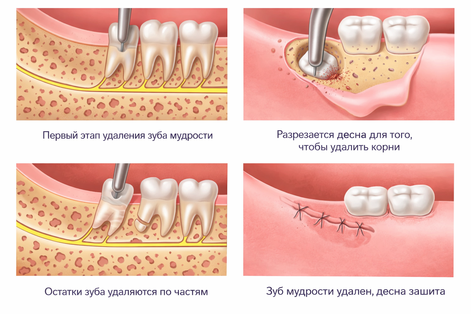 удаление зуба мудрости