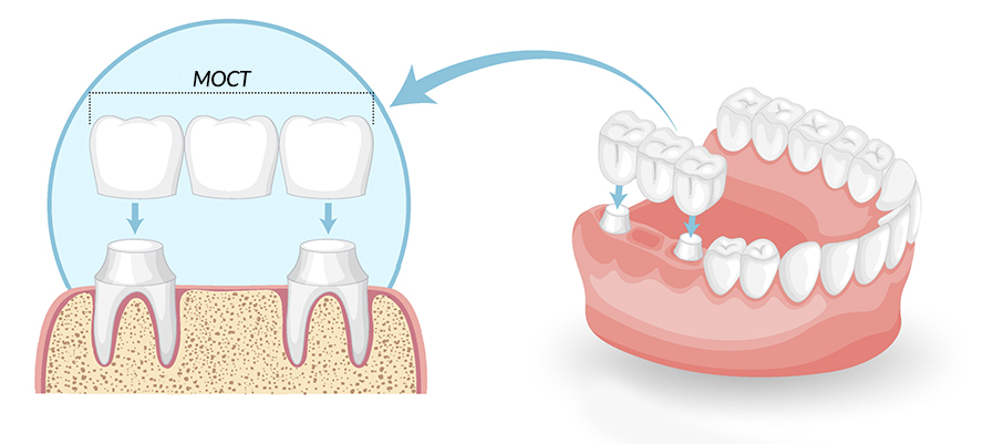 Зубные мосты: когда они являются альтернативой имплантации