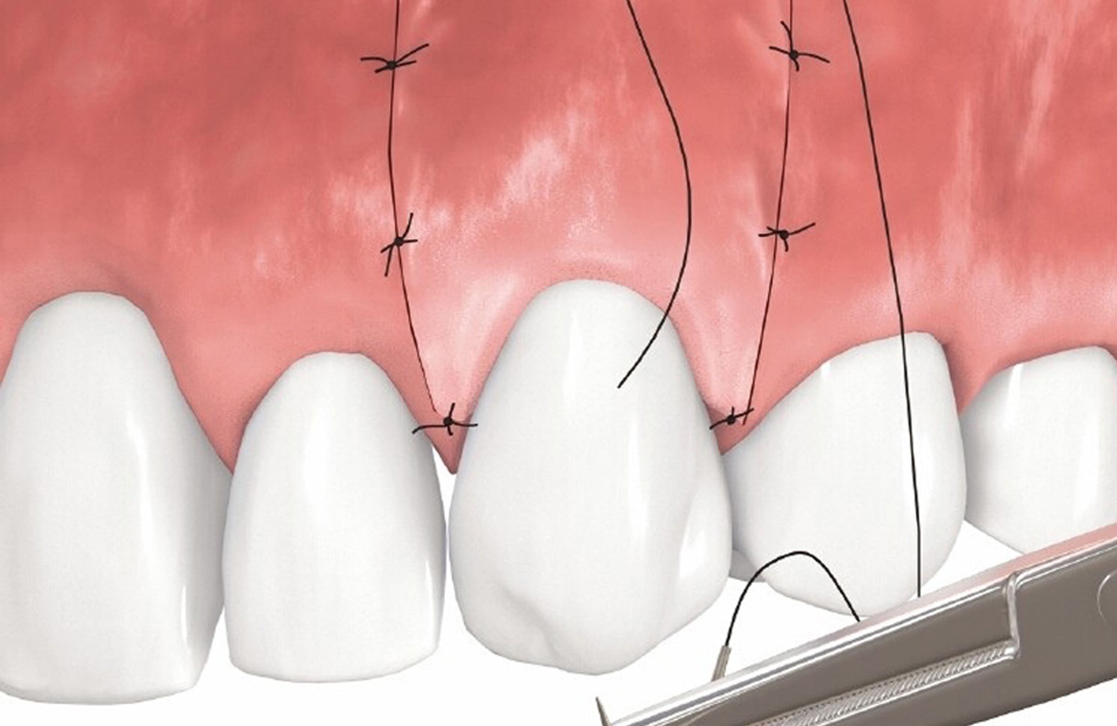 лоскутная операция на десне