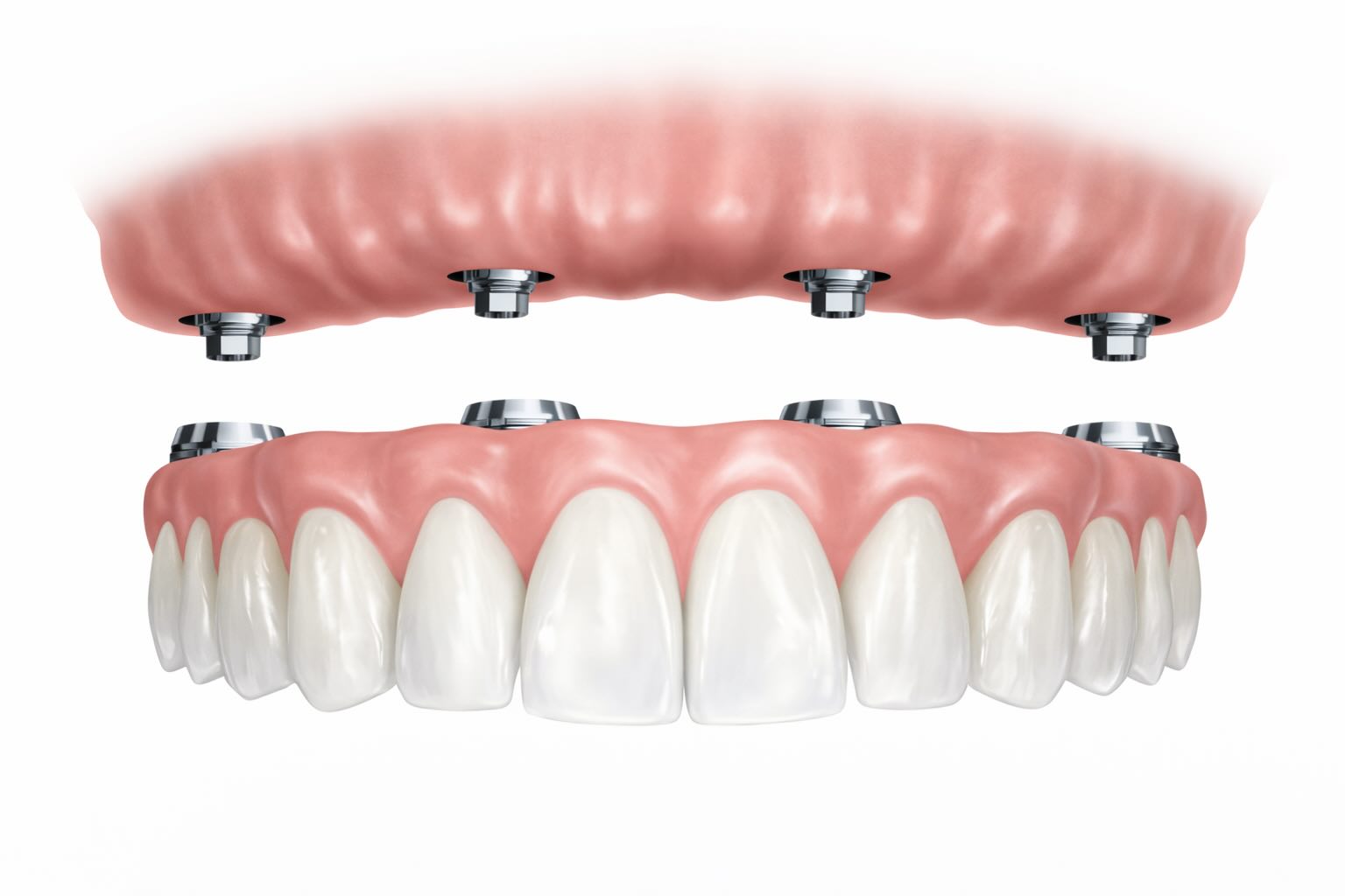 Имплантация при полном отсутствии зубов