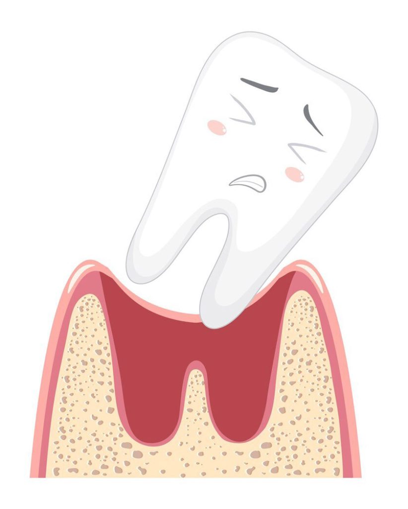 альвеолит зуба