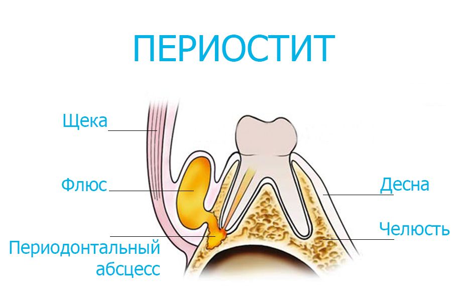 Как лечить периостит?