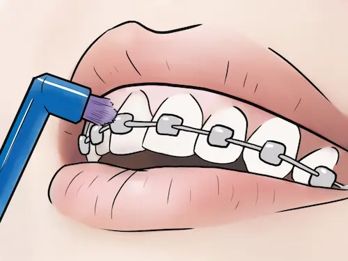 как ухаживать за брекетами