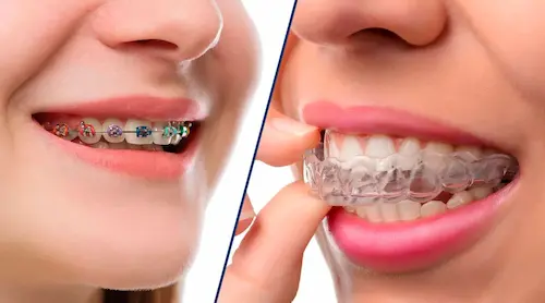 виды брекетов для взрослых