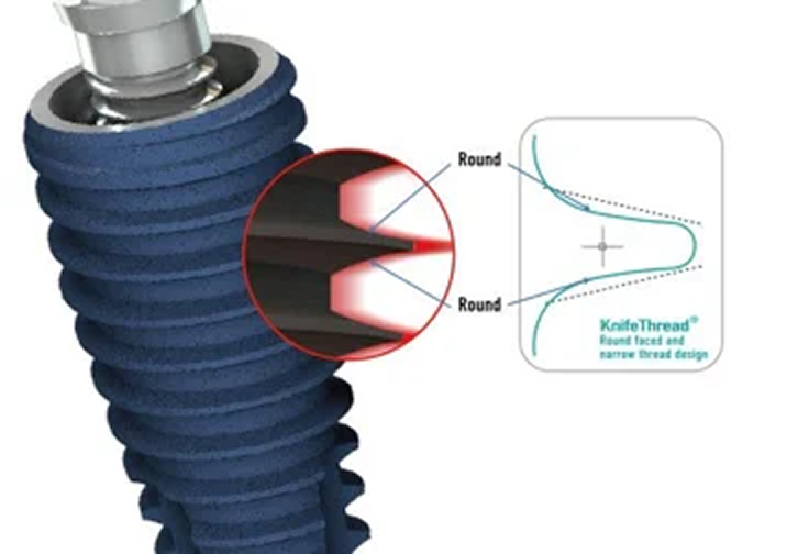 Система AnyRidge — решение для сложных случаев