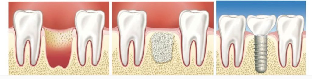 этапы аугментации зубов