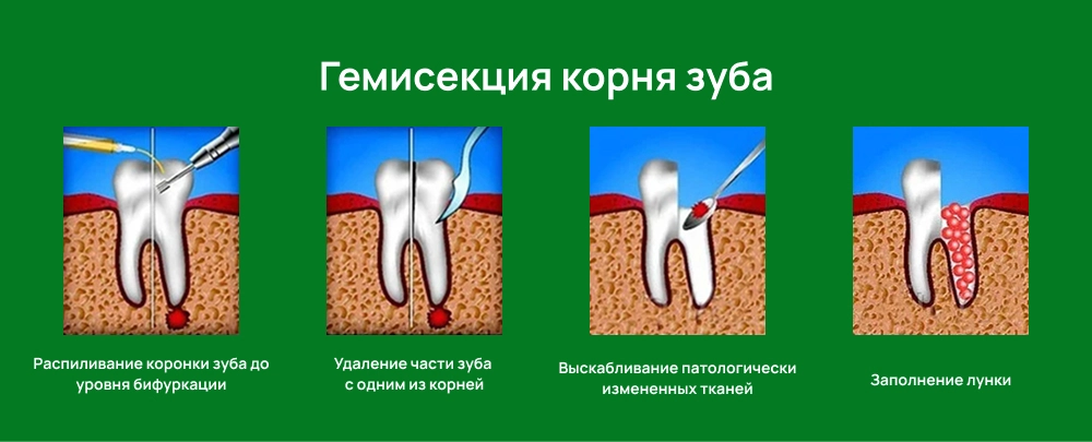 гемисекция зуба
