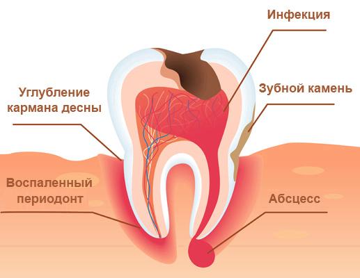 симптомы кисты зуба