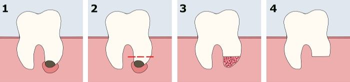 этапы резекции корня зуба