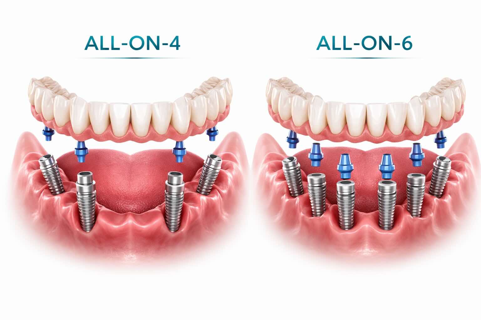 Имплантация зубов all‑on‑4/6