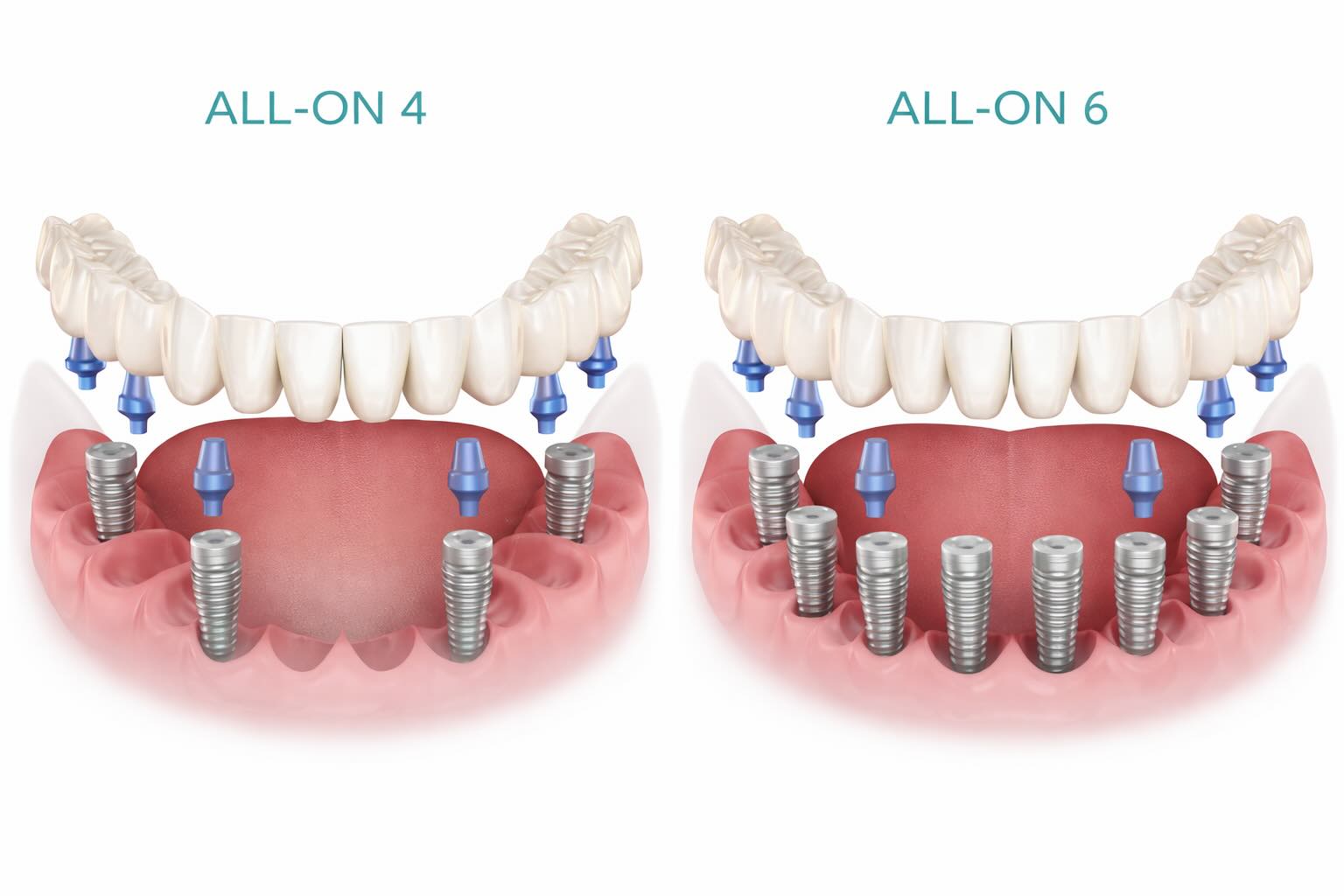 Имплантация зубов all‑on‑4/6