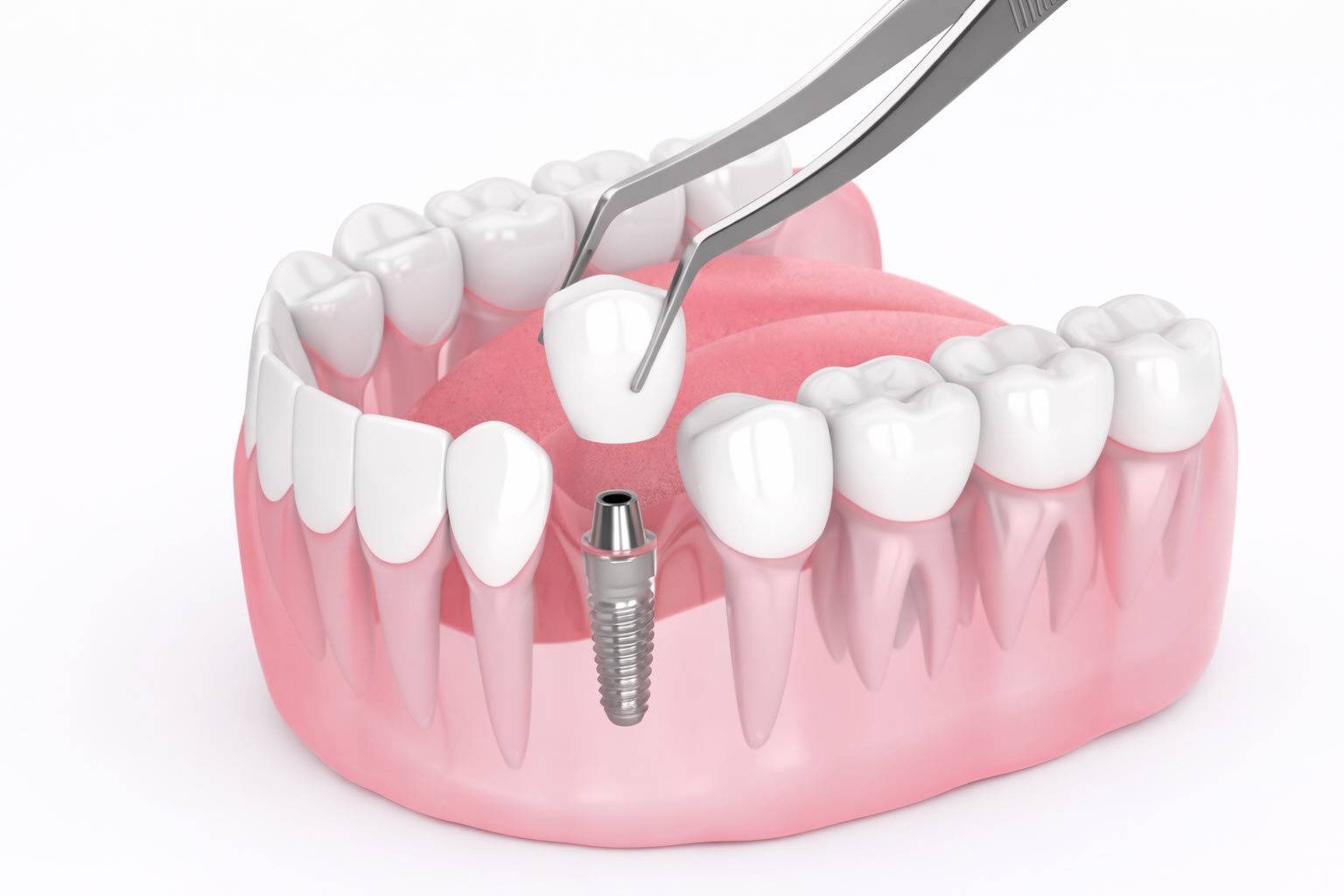 Implantaciya zubov v odin etap ustanovka implanta i koronki 3D illustraciya