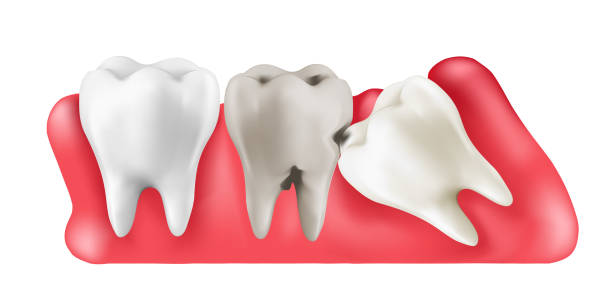 перикоронарит зуба