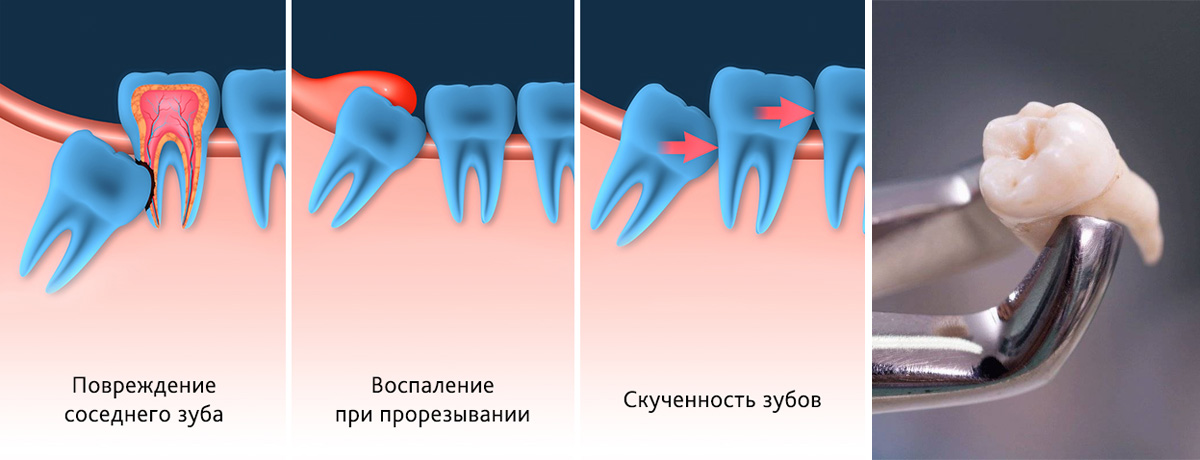 причины удаления зубов мудрости