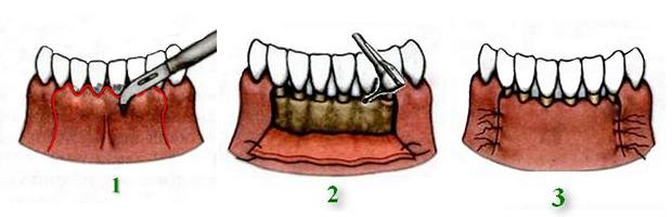 лоскутная операция на десне