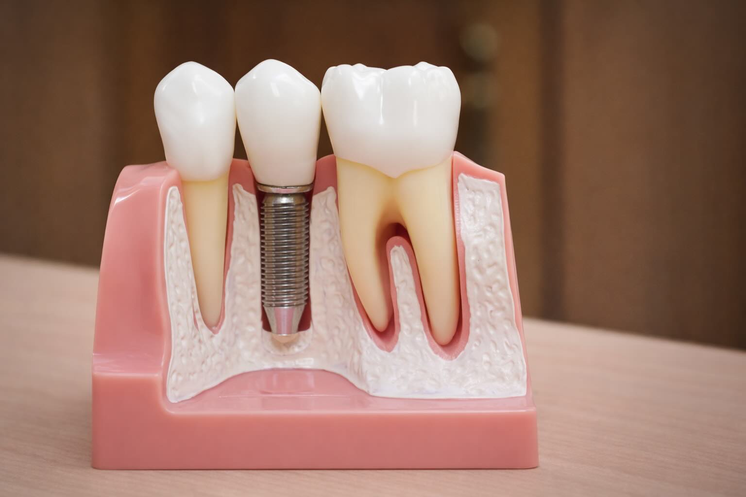 Синус-лифтинг верхней челюсти &mdash; 3D иллюстрация процедуры