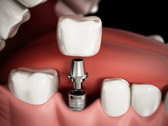 Кому подходят зубные импланты?