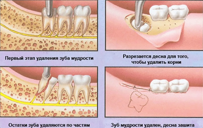удаление зуба мудрости