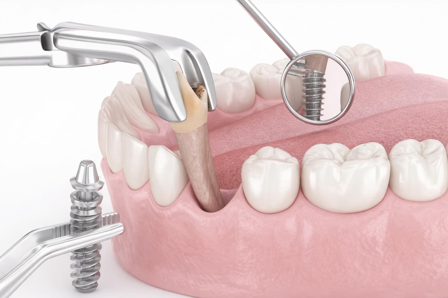 Ustanovka zubnogo implanta srazu posle udaleniya zuba 3D illustraciya