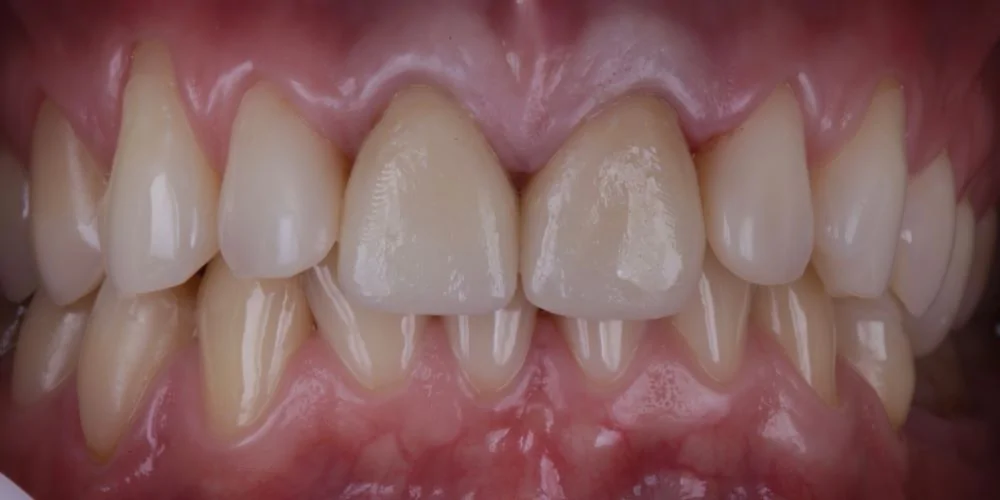Протезирование коронками Cerec-after
