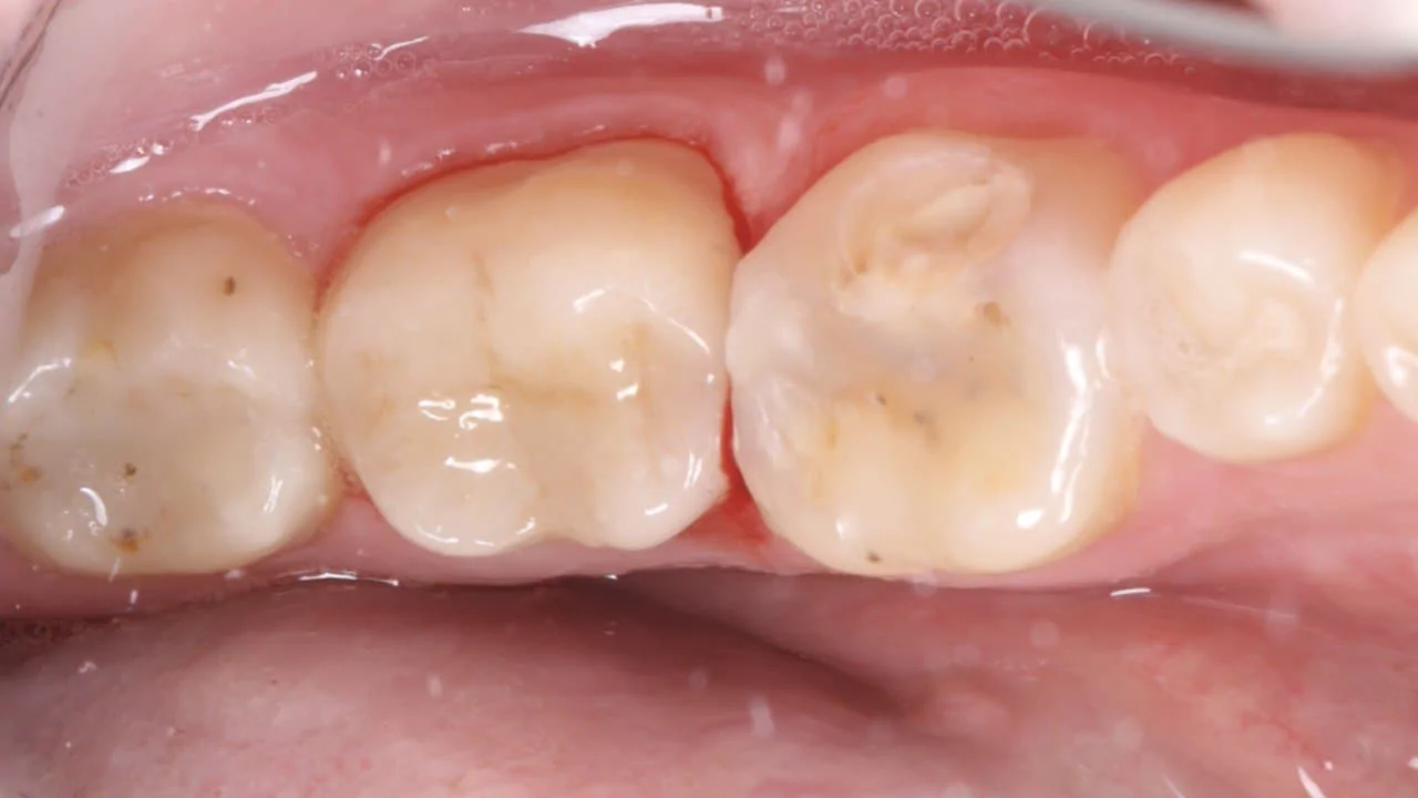 Протезирование зуба коронкой Cerec - за 2 часа!-after