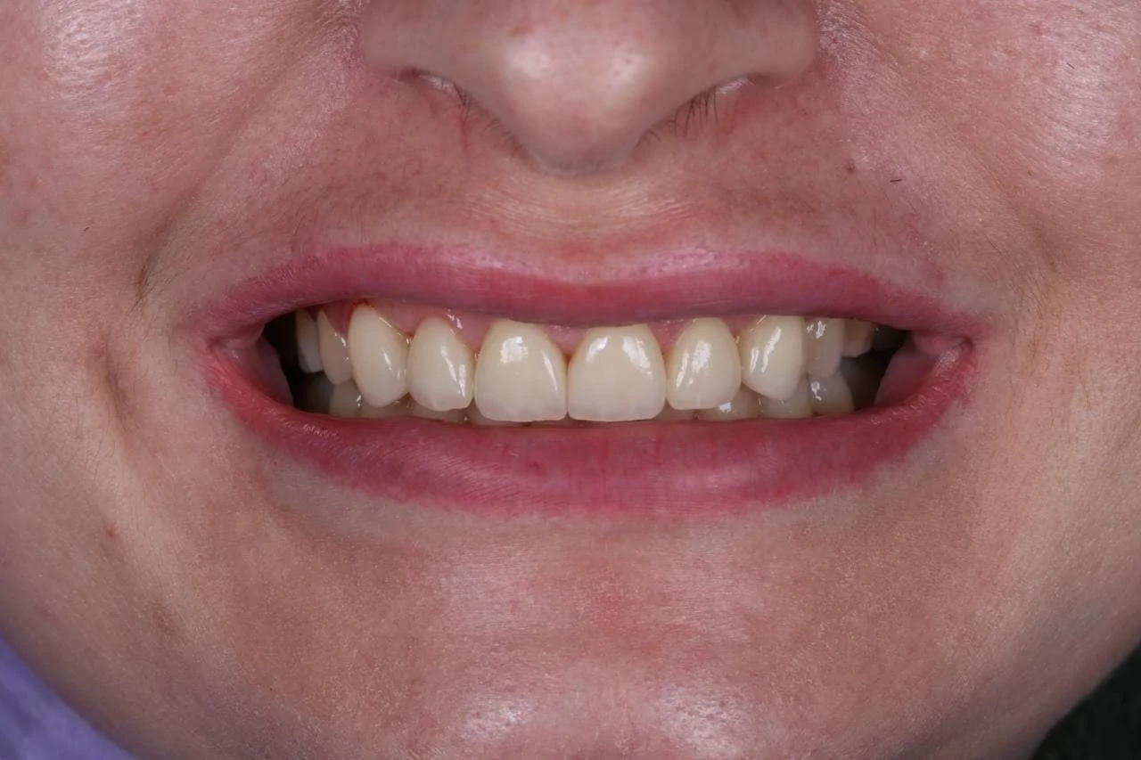 Протезирование зубов коронками Cerec-after