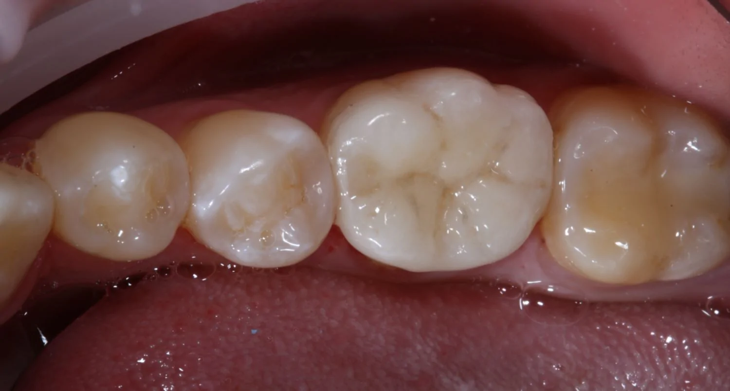 Протезирование зуба коронкой Cerec-after