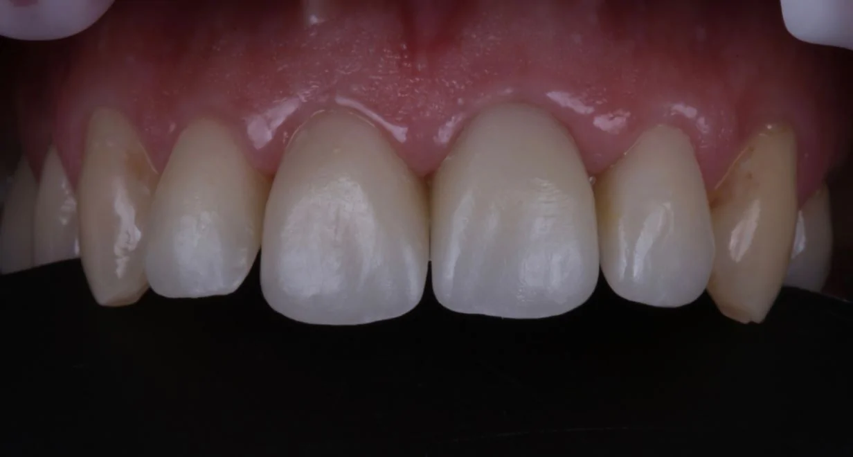 Протезирование коронками Cerec (4 передних зуба)-after