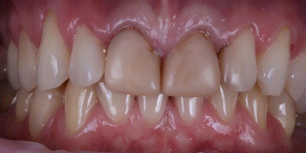 Протезирование коронками Cerec-before