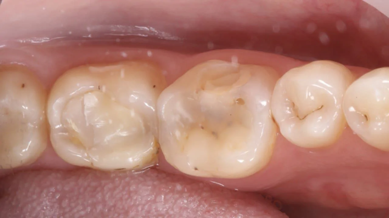 Протезирование зуба коронкой Cerec - за 2 часа!-before