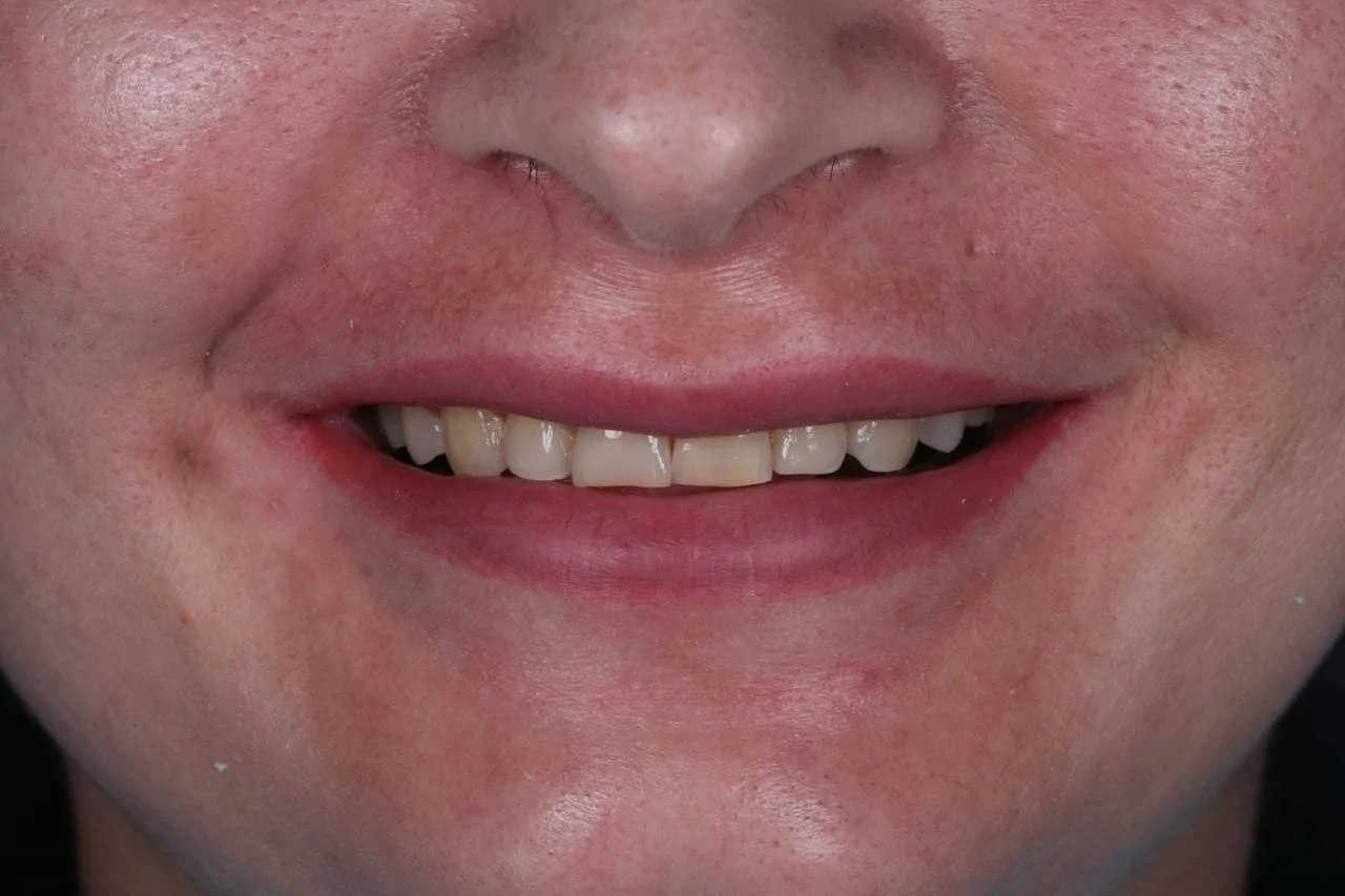 Протезирование зубов коронками Cerec-before
