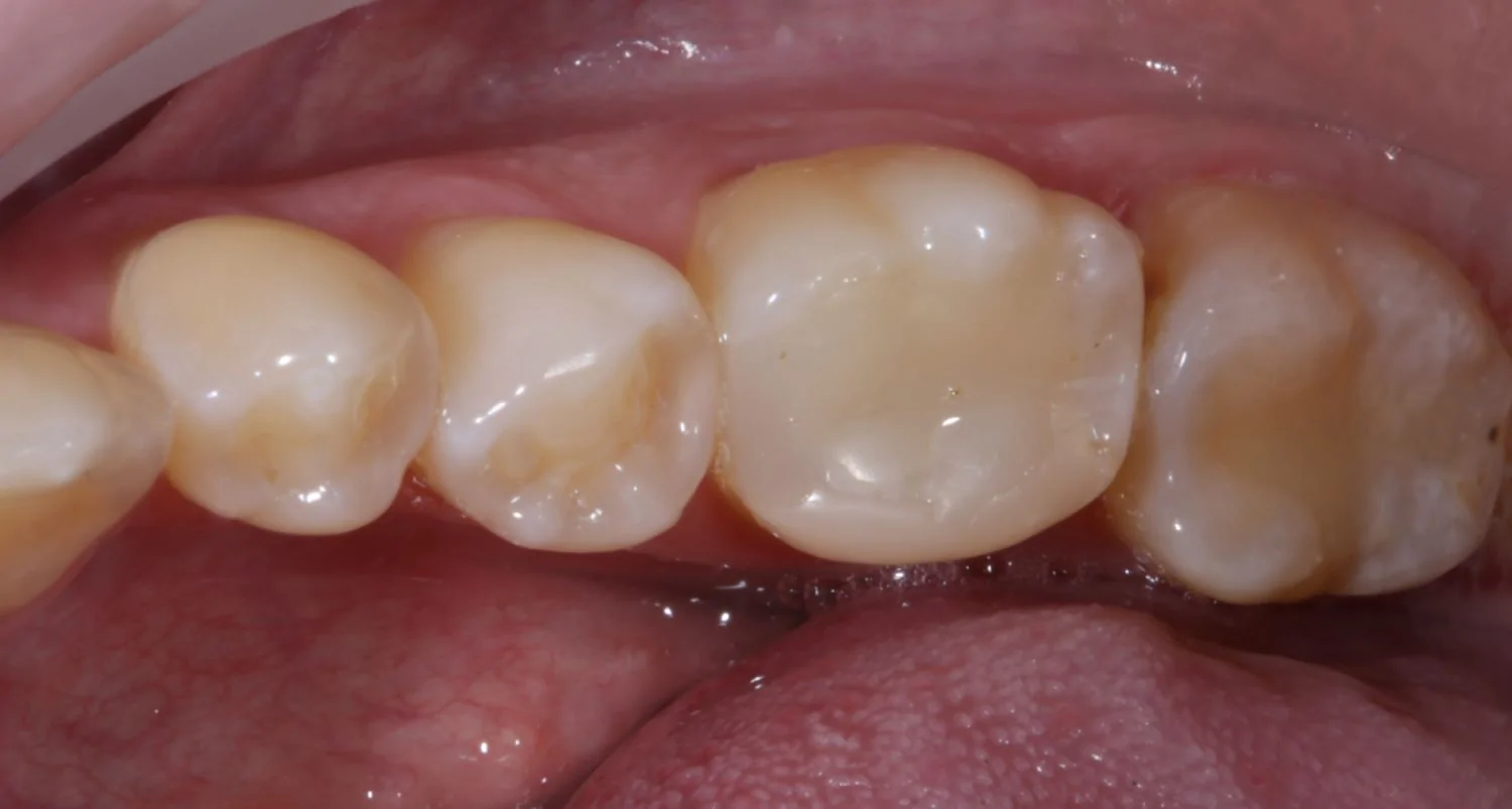 Протезирование зуба коронкой Cerec-before
