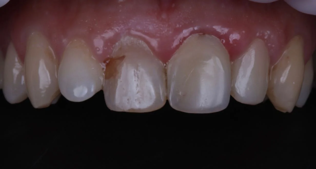 Протезирование коронками Cerec (4 передних зуба)-before