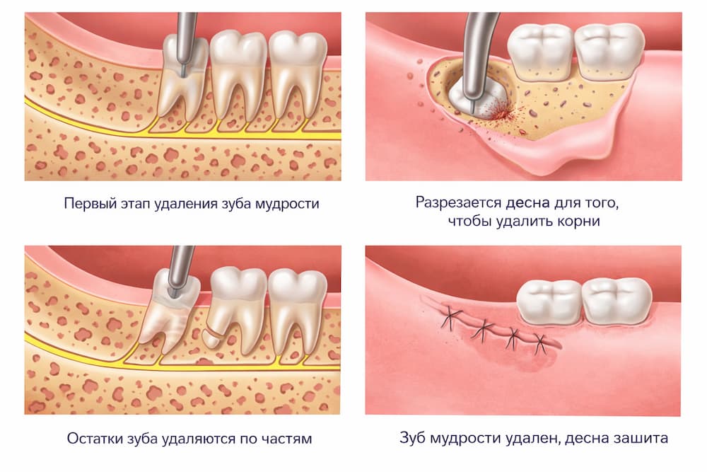 этапы удаления зуба мудрости