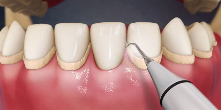 Откуда берутся камни на зубах и как избежать их появления?